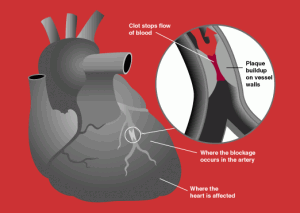 heart-attack-diagram