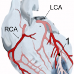 heart-attack-diagram1