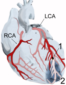 heart-attack-diagram1